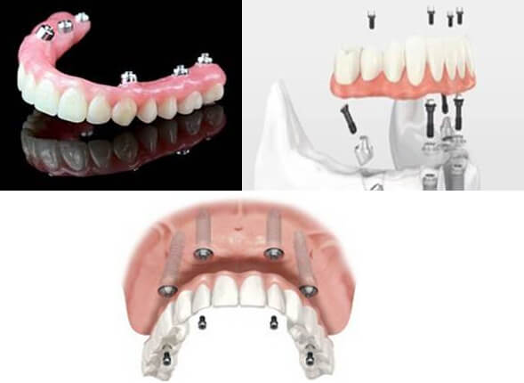 Implant Retained Dentures