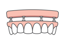 Implant Retained Dentures Icon