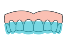 Mouthguards