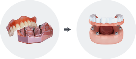 Implant Retained Dentures Image1