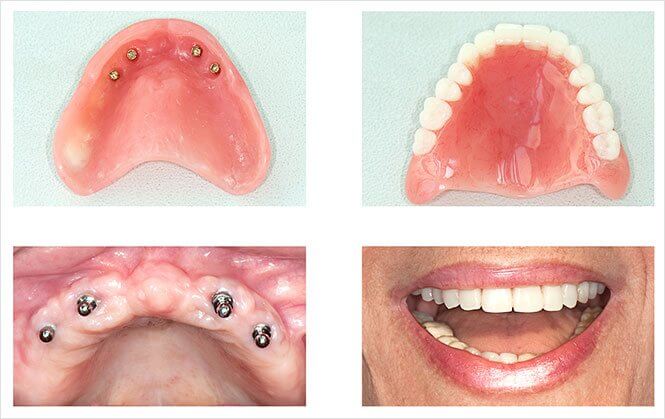 Implant Retained Dentures Image2