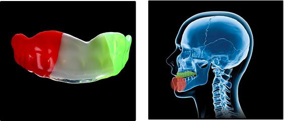 Mouthguards Image1