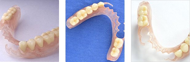 Partial Dentures Image1