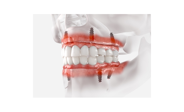 What Is An Implant Retained Denture